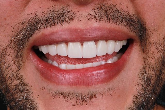 Después diseño dental